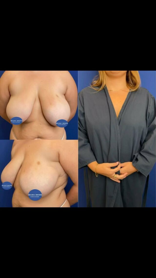 ✨Less is more!✨
Look at this amazing transformation by our very own Dr. Yalamanchili. 
Procedure🩺 Breast Reduction
Anesthesia💉 General; 2.5-3 hours. 
•
•
 #plasticsurgery #plasticsurgerywashingtondc #plasticsurgeon #plasticsurgerymaryland #cosmetics #cosmeticsurgery #aestheticsurgery #aesthetics#plasticsurgerybeforeandafter #plasticsurgeryinstagram #topsurgery #nationalcenterforplasticsurgery #americanboardofplasticsurgery #weightlosssurgery #washingtoniantopdoc
#boardcertifiedplasticsurgeon #breastreduction #breastsurgery